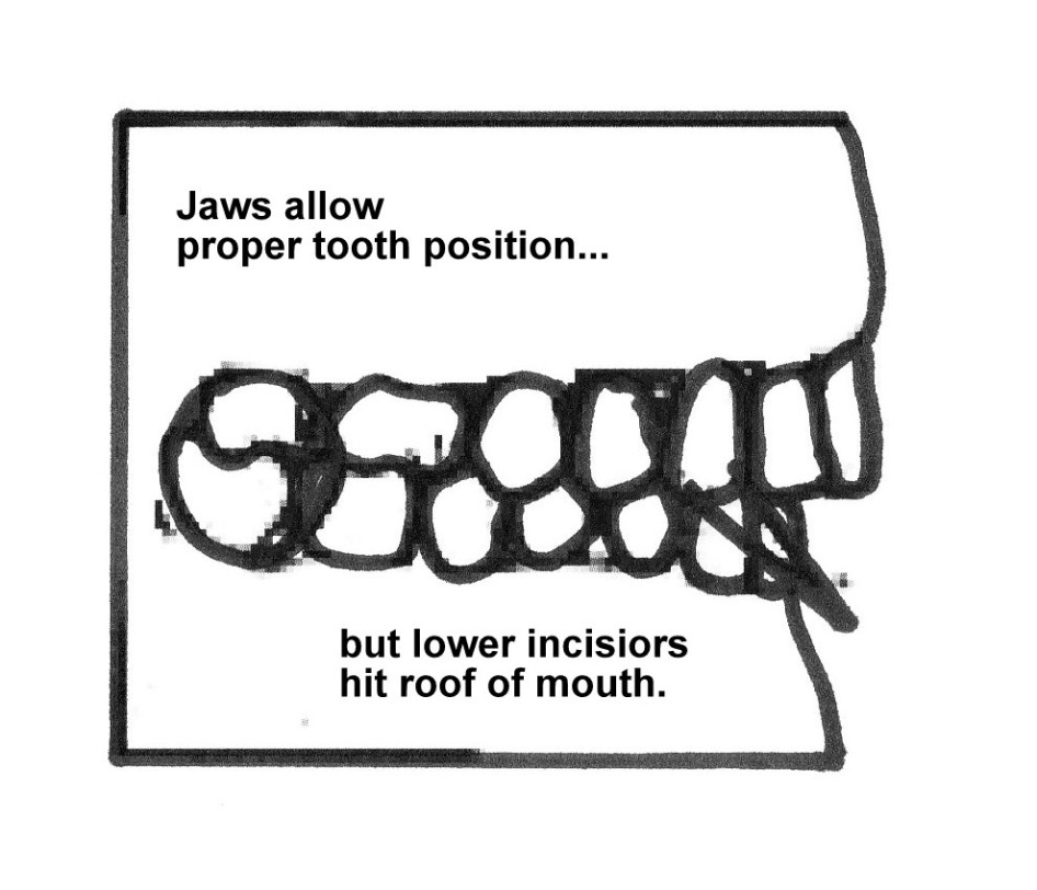 Closed Bite Orthodontics San Pedro Eric Kardovich DMD