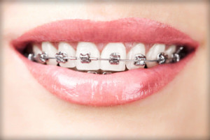 Metal Braces