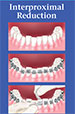 Interproximal-Reduction_75