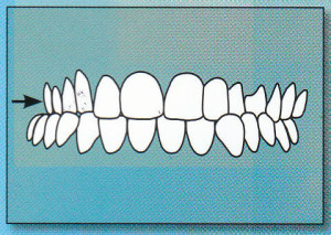 CROSSBITE:  Upper back teeth fit inside lower back teeth