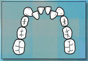 CROWDING:  Teeth are crowded, not enough space