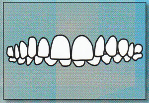 DEEP BITE:  Upper front teeth                 overlap lower front teeth too much