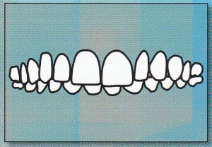 DEEP BITE: Upper front teeth overlap lower front teeth too much