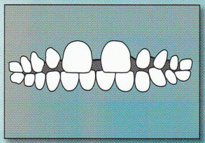 EXCESS SPACING:  There is too much space between the teeth