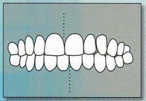 MID-LINES NOT ALIGNED:  Mid-lines of upper and lower teeth do not line up