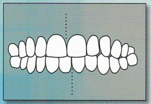 MID-LINES NOT ALIGNED: Mid-lines of upper and lower teeth do not line up