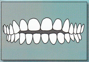 OPEN BITE:  Back teeth are together, but there is too much space between the front upper and lower teeth protrude