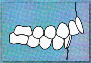 OVERJET: Upper front teeth protrude