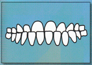UNDERBITE: Lower front teeth protrude